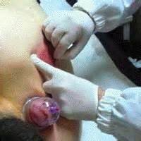 Hijama 3